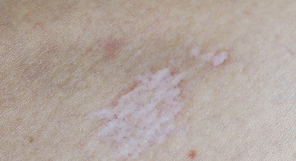 Vulval itching lichen sclerosus assessment and management case study