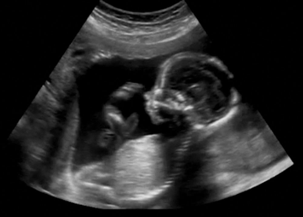 Management Of The Small For Gestational Age Fetus